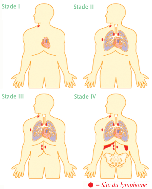 La classification des stades du lymphome