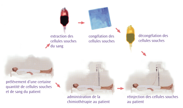 Greffe autologue Greffe autologue