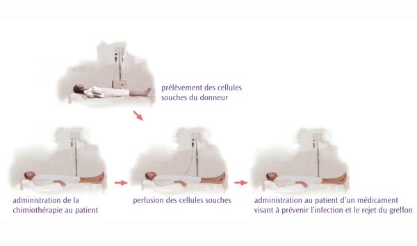 Greffe allogénique Greffe allogénique